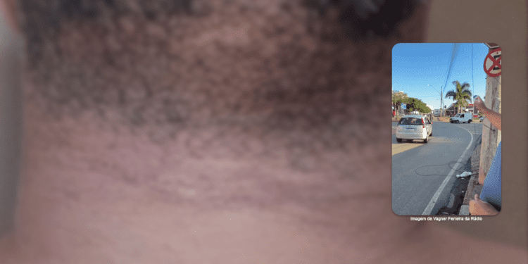 Marca no pescoço de motociclista após acidente com cabo solto em Itabira